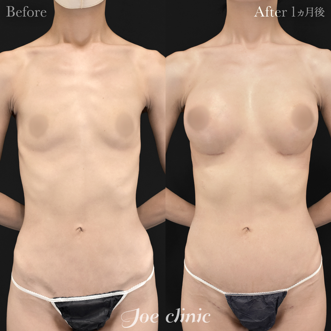 【40代女性】ハイブリッド豊胸(シリコンバッグ豊胸+脂肪幹細胞注入豊胸)|1ヵ月後