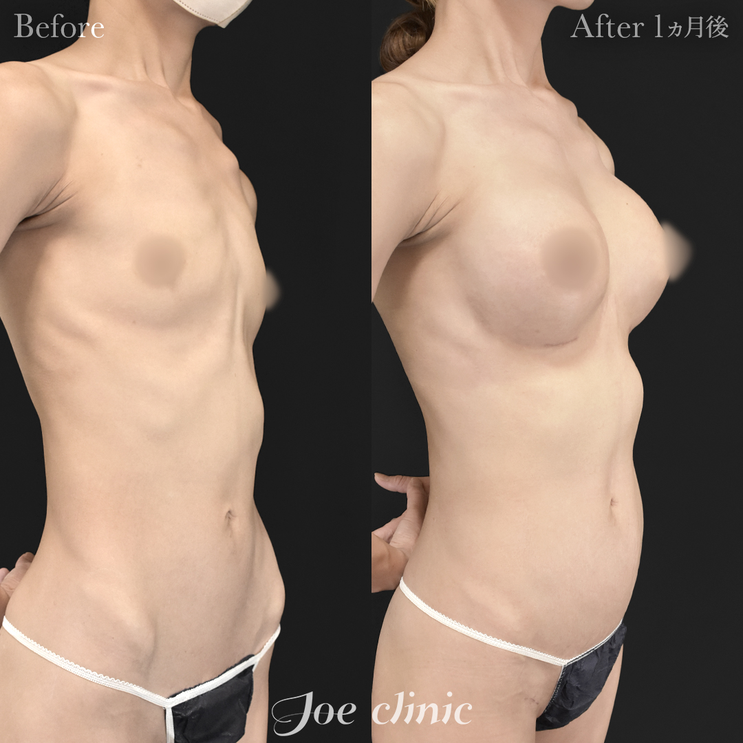 【40代女性】ハイブリッド豊胸(シリコンバッグ豊胸+脂肪幹細胞注入豊胸)|1ヵ月後