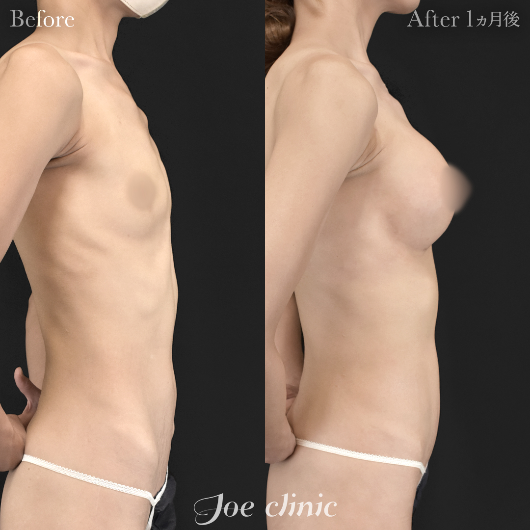 【40代女性】ハイブリッド豊胸(シリコンバッグ豊胸+脂肪幹細胞注入豊胸)|1ヵ月後