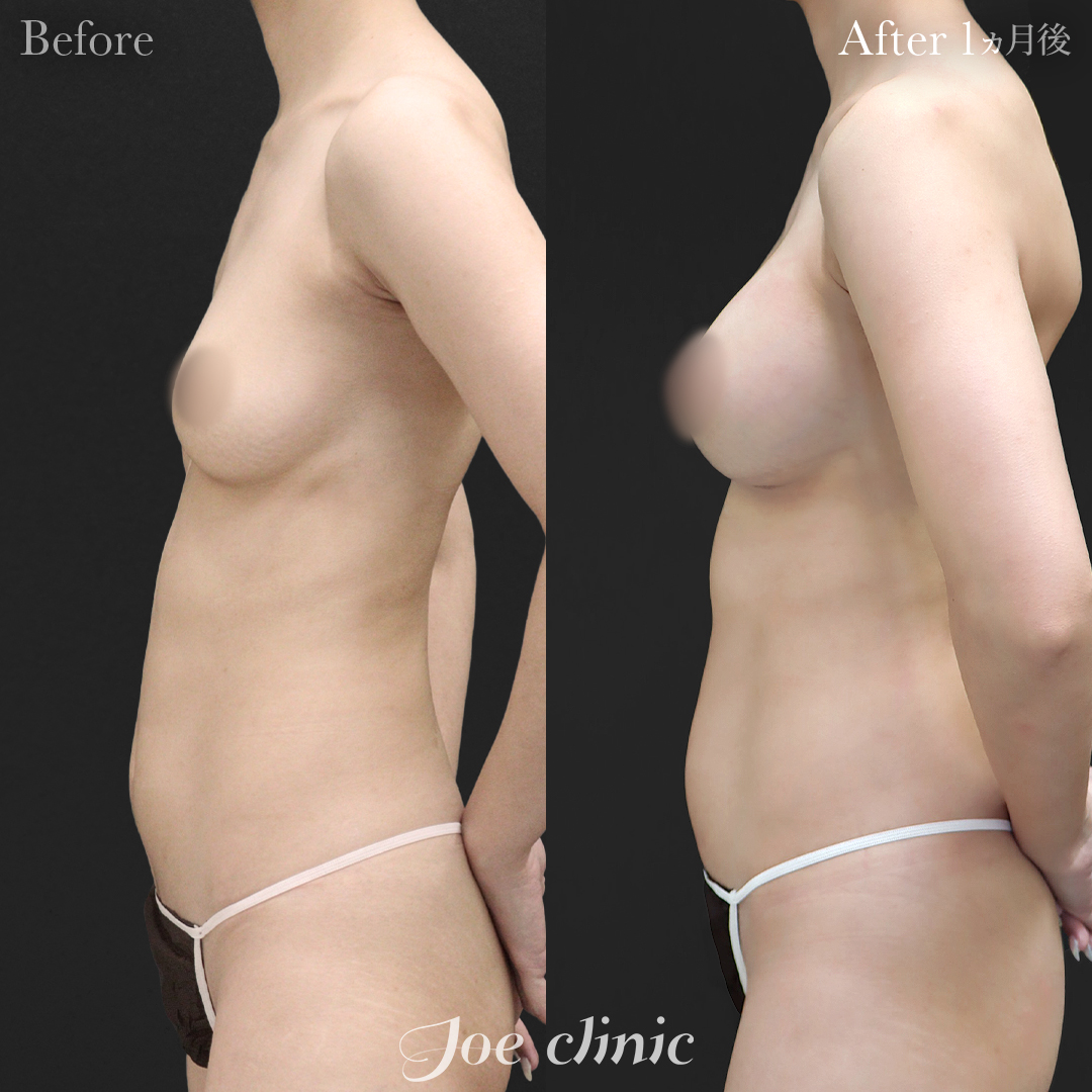【30代女性・他院修正】脂肪注入しこり除去後のシリコンバッグ豊胸（右360cc・左200cc）｜1ヵ月後