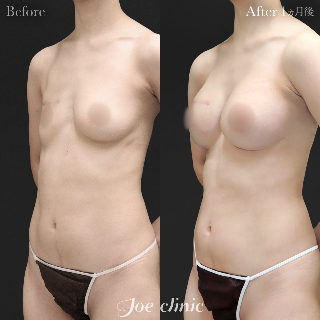 【30代女性・他院修正】脂肪注入しこり除去後のシリコンバッグ豊胸（右360cc・左200cc）｜1ヵ月後