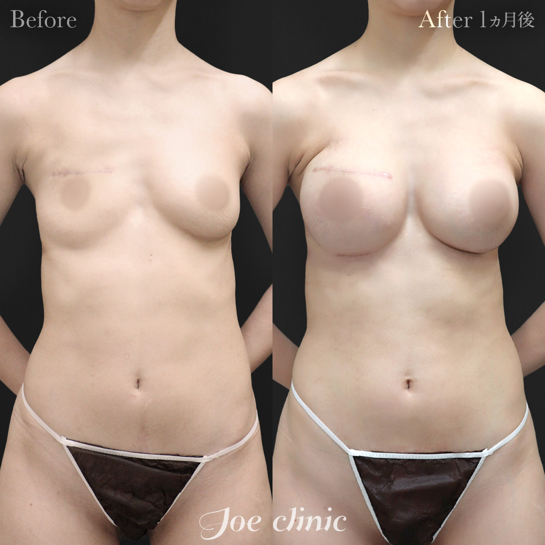 【30代女性・他院修正】脂肪注入しこり除去後のシリコンバッグ豊胸（右360cc・左200cc）｜1ヵ月後