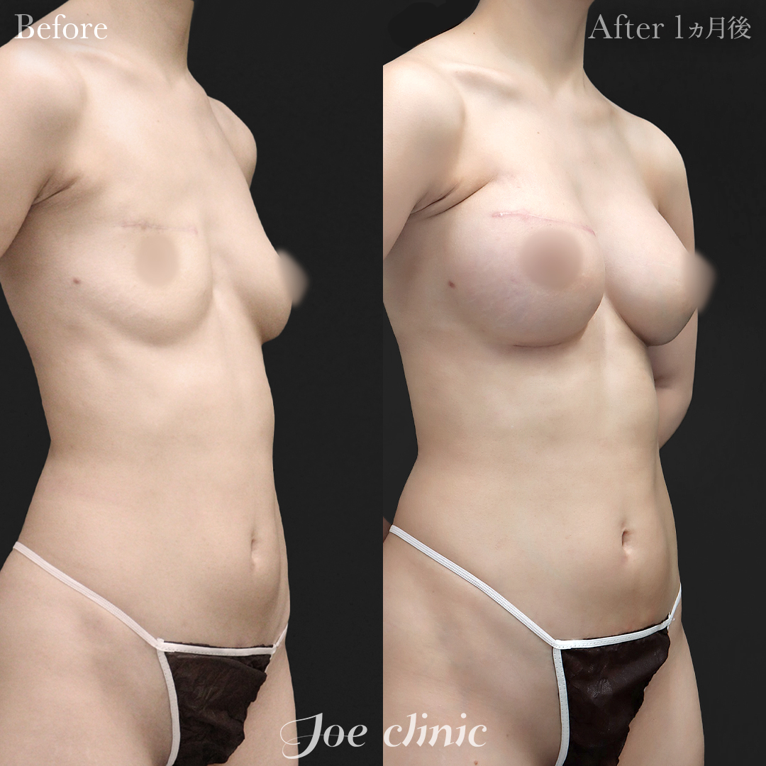 【30代女性・他院修正】脂肪注入しこり除去後のシリコンバッグ豊胸(右360cc・左200cc)|1ヵ月後