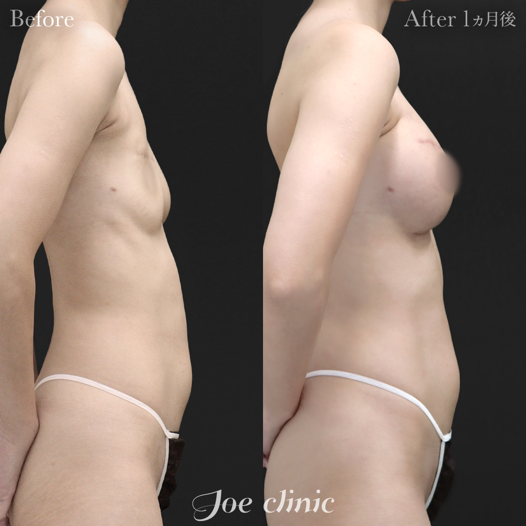 【30代女性・他院修正】脂肪注入しこり除去後のシリコンバッグ豊胸（右360cc・左200cc）｜1ヵ月後