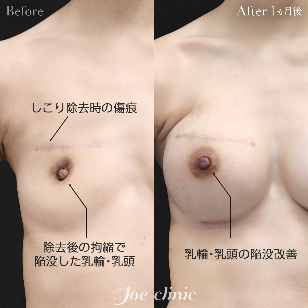 【30代女性・他院修正】脂肪注入しこり除去後のシリコンバッグ豊胸（右360cc・左200cc）｜1ヵ月後