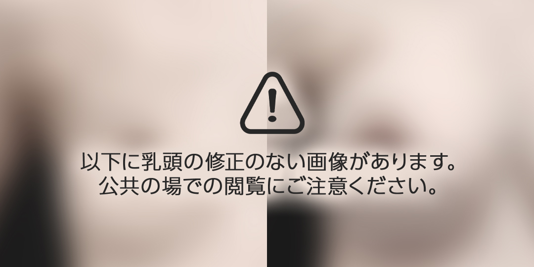 【30代女性・他院修正】脂肪注入しこり除去後のシリコンバッグ豊胸（右360cc・左200cc）｜1ヵ月後