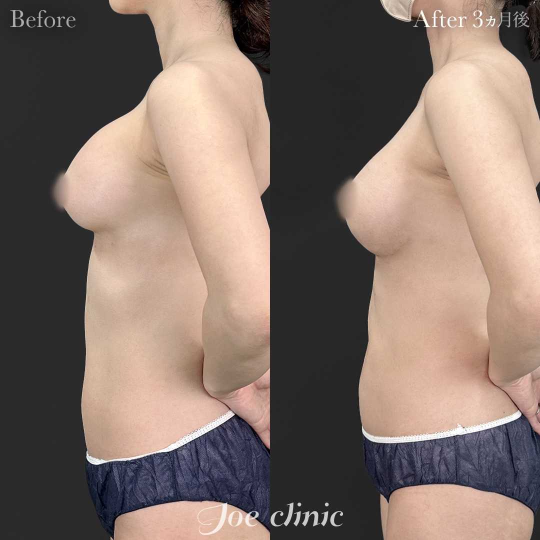 【30代女性・他院修正】他院バッグ入れ替え（290cc×左右）｜3ヵ月後