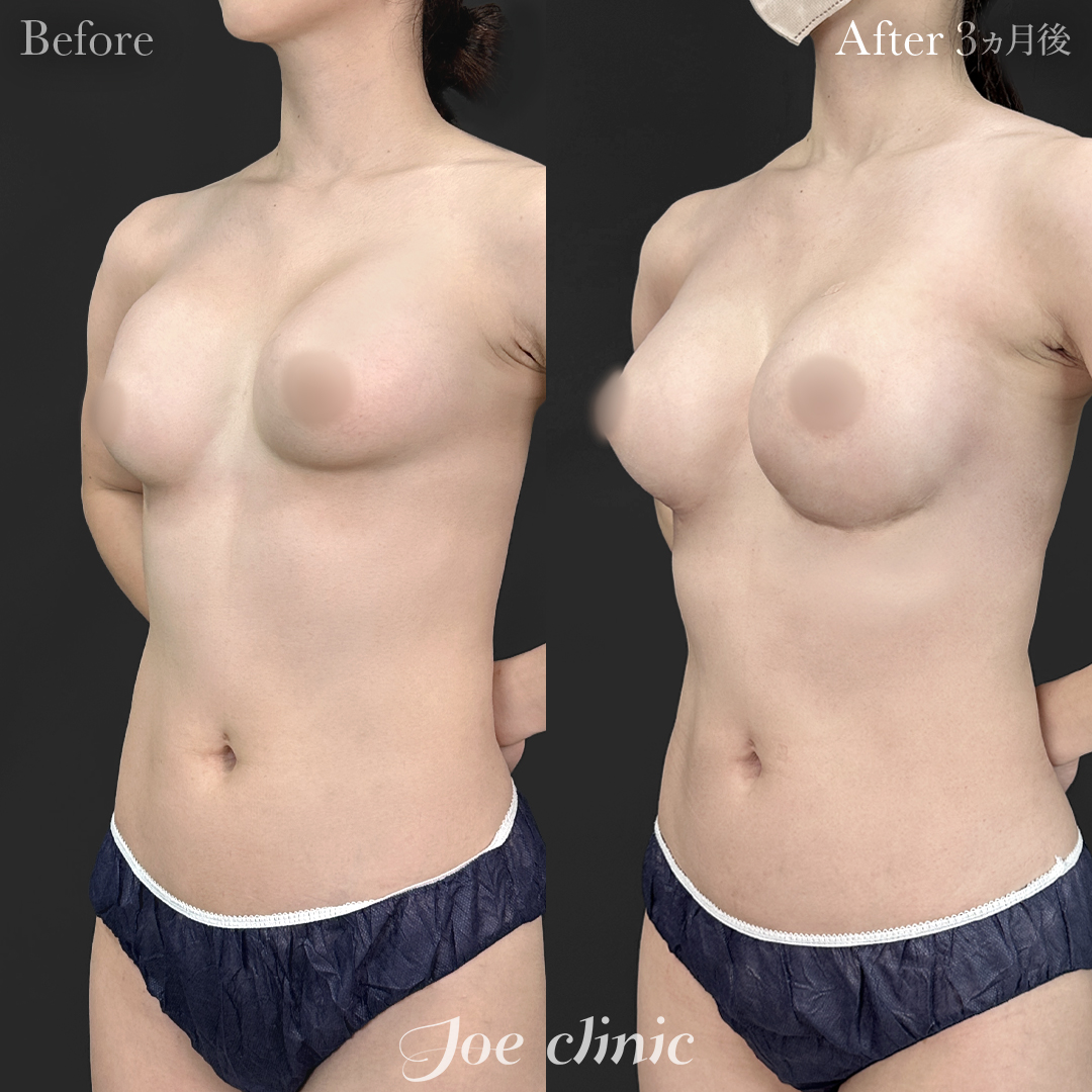 【30代女性・他院修正】他院バッグ入れ替え（290cc×左右）｜3ヵ月後