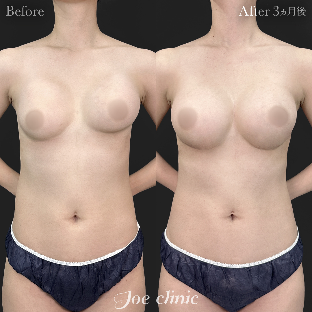 【30代女性・他院修正】他院バッグ入れ替え（290cc×左右）｜3ヵ月後