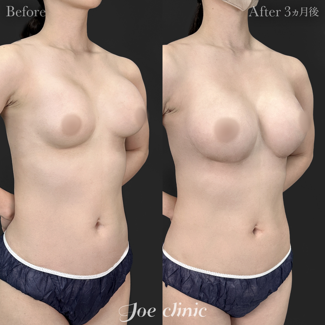 【30代女性・他院修正】他院バッグ入れ替え（290cc×左右）｜3ヵ月後