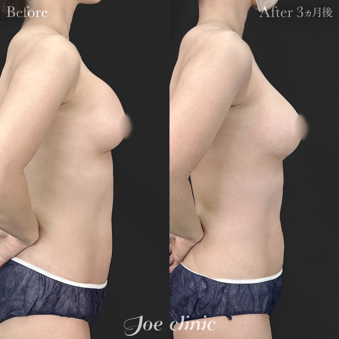 【30代女性・他院修正】他院バッグ入れ替え（290cc×左右）｜3ヵ月後