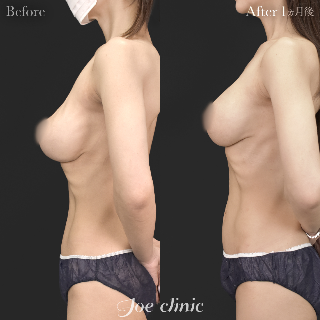 【40代女性・他院修正】他院バッグ入れ替え（450cc×左右）｜1ヵ月後