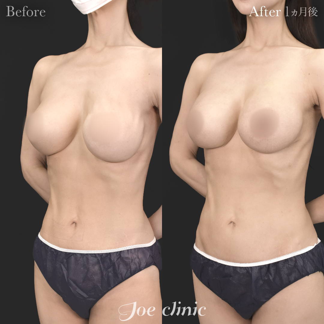 【40代女性・他院修正】他院バッグ入れ替え（450cc×左右）｜1ヵ月後