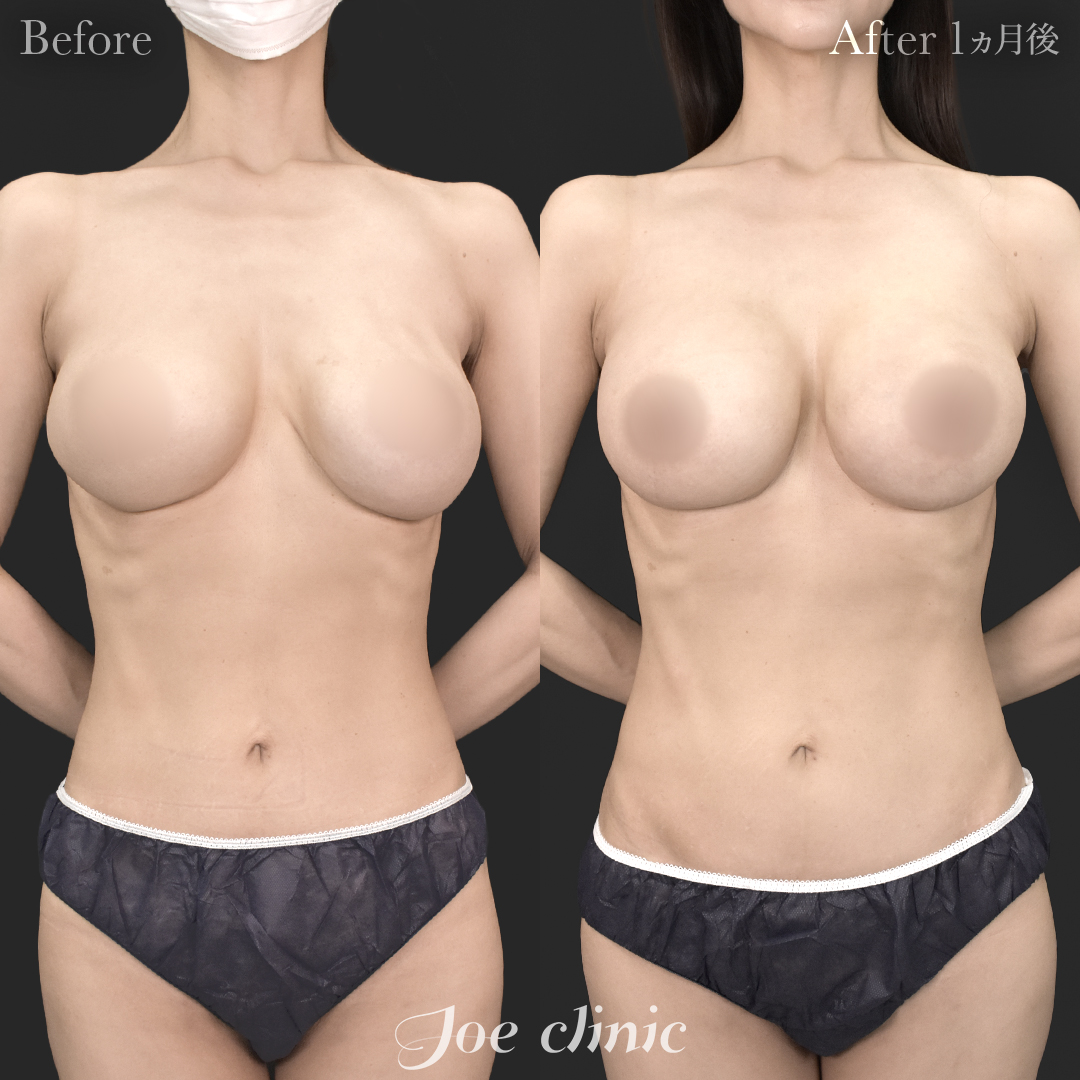 【40代女性・他院修正】他院バッグ入れ替え（450cc×左右）｜1ヵ月後