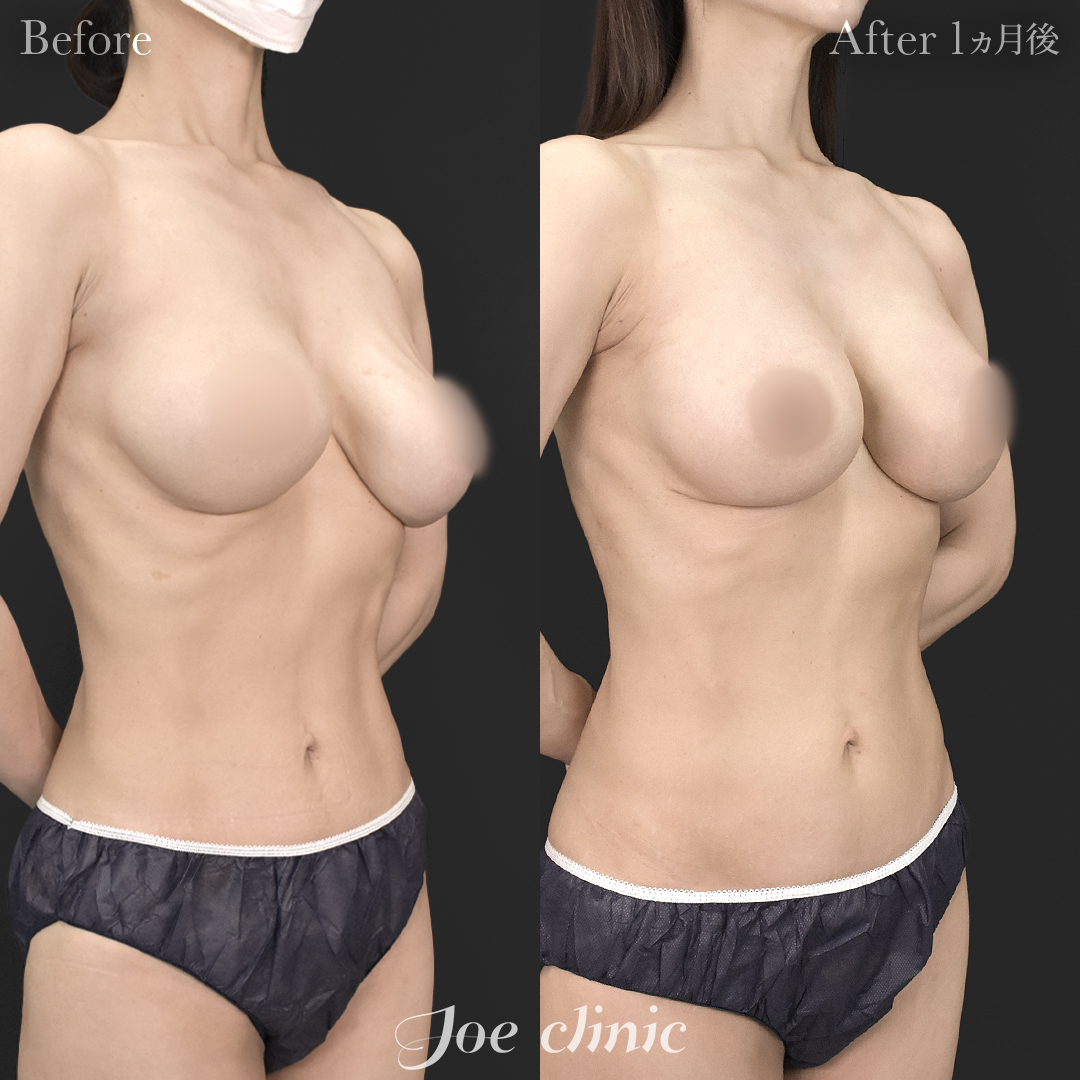 【40代女性・他院修正】他院バッグ入れ替え（450cc×左右）｜1ヵ月後