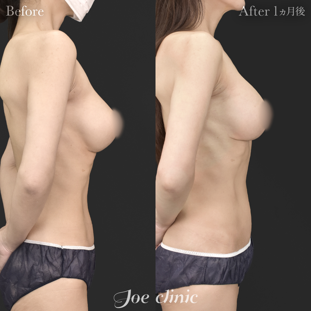 【40代女性・他院修正】他院バッグ入れ替え（450cc×左右）｜1ヵ月後