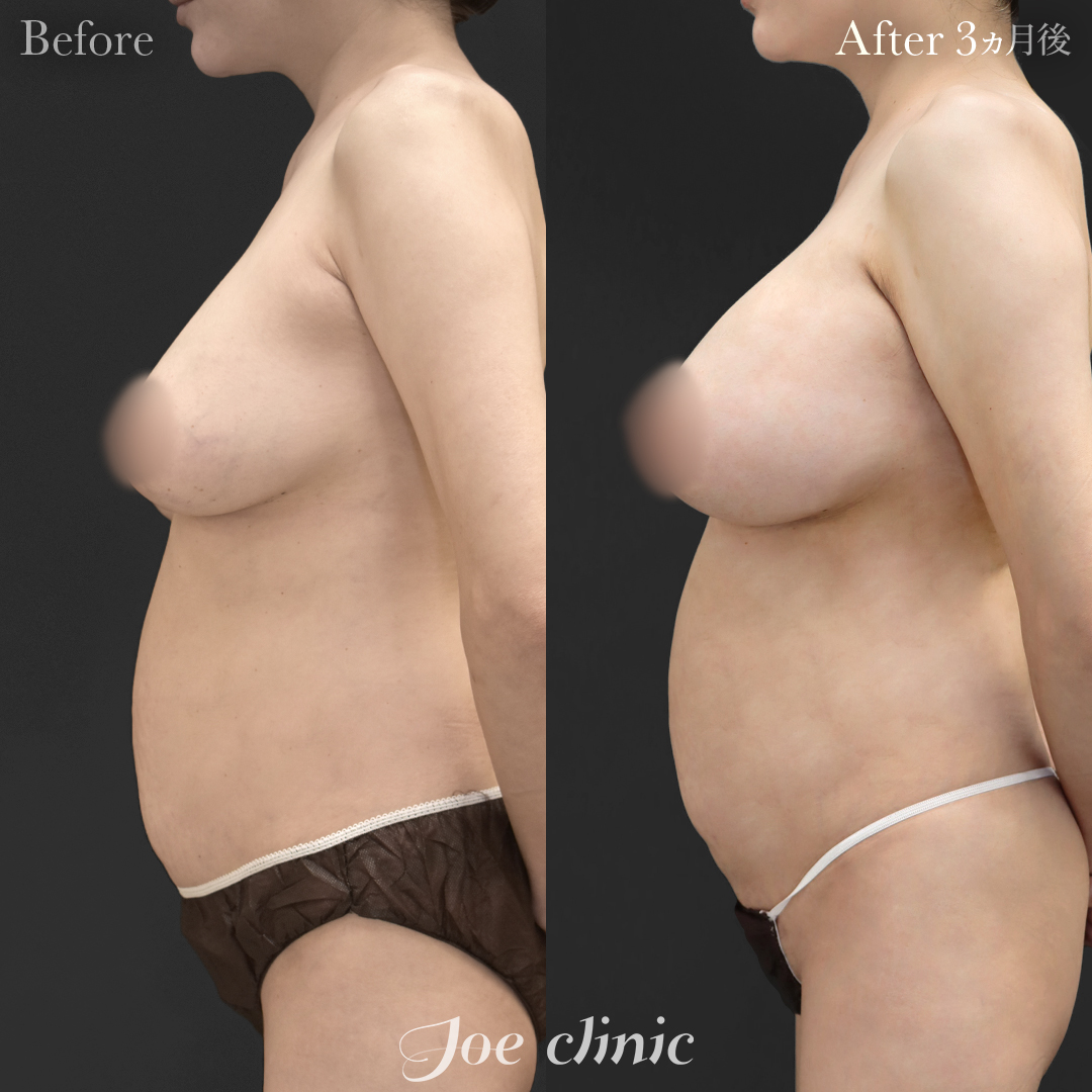 【40代女性・他院修正】他院バッグ入れ替え（545cc×左右）｜3ヵ月後