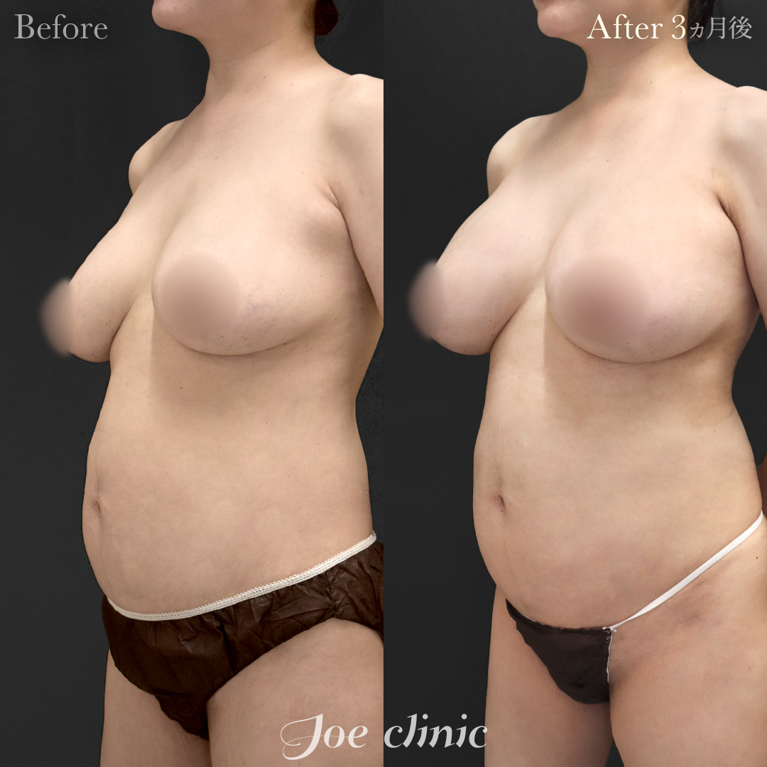 【40代女性・他院修正】他院バッグ入れ替え（545cc×左右）｜3ヵ月後