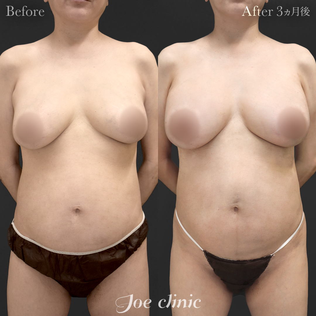 【40代女性・他院修正】他院バッグ入れ替え（545cc×左右）｜3ヵ月後