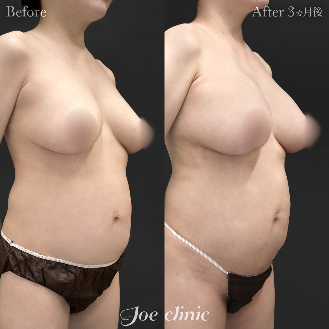 【40代女性・他院修正】他院バッグ入れ替え（545cc×左右）｜3ヵ月後
