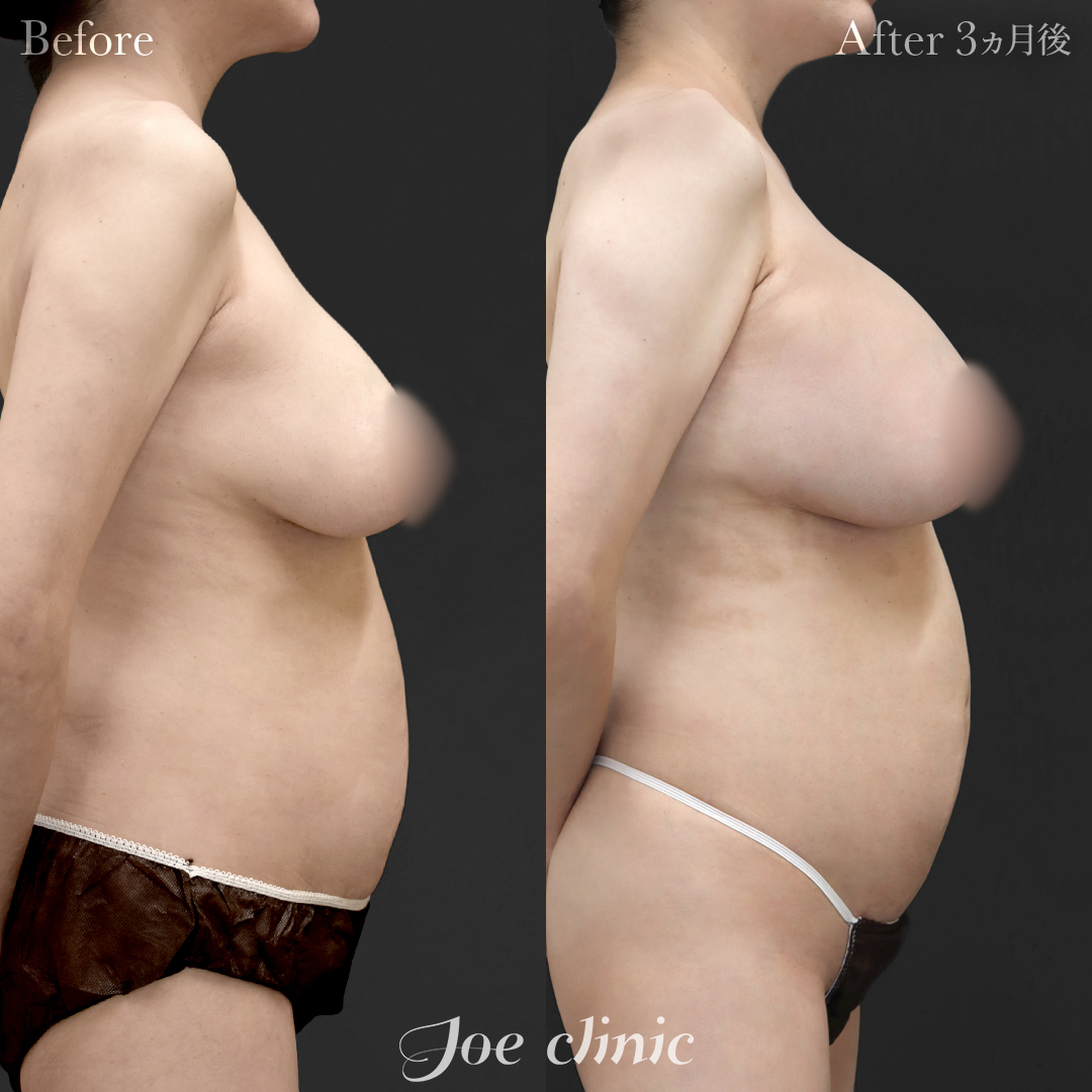 【40代女性・他院修正】他院バッグ入れ替え（545cc×左右）｜3ヵ月後