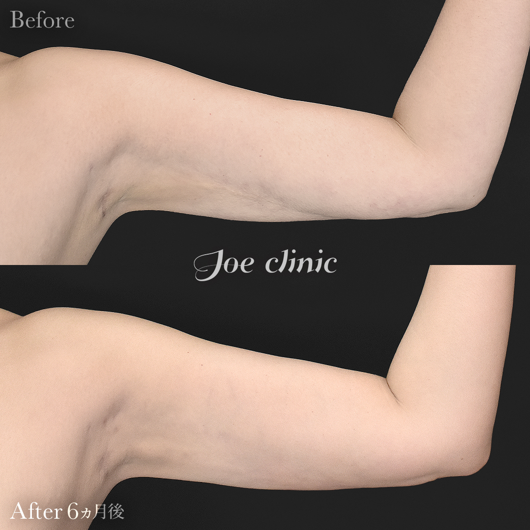 【40代女性・他院修正】脂肪吸引（二の腕）+ナノファット注入｜6ヵ月後