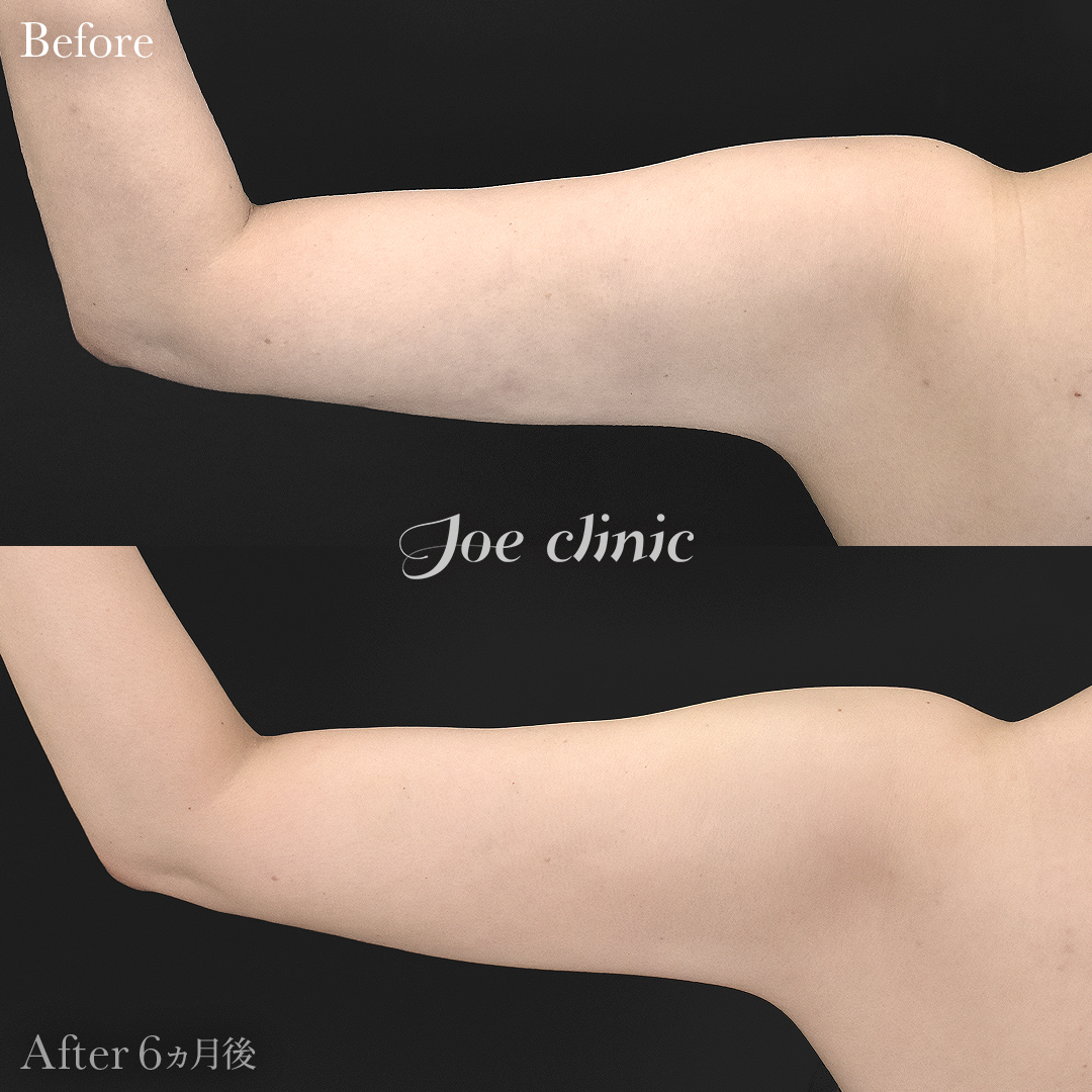 【40代女性・他院修正】脂肪吸引（二の腕）+ナノファット注入｜6ヵ月後