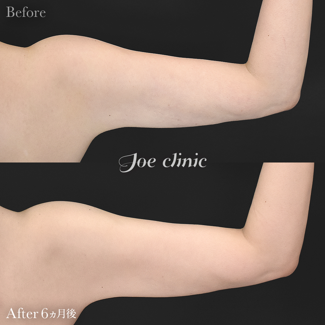 【40代女性・他院修正】脂肪吸引（二の腕）+ナノファット注入｜6ヵ月後