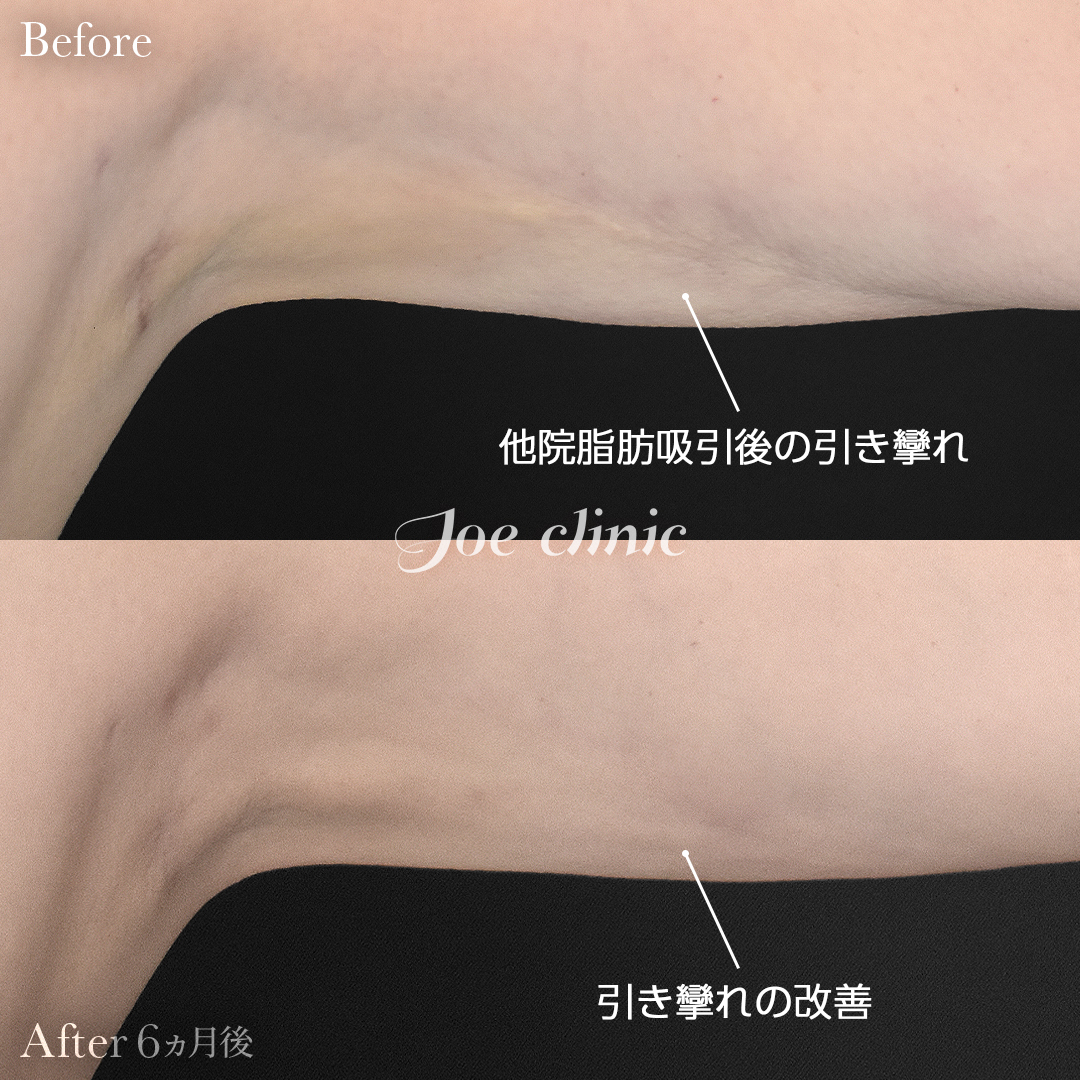 【40代女性・他院修正】脂肪吸引（二の腕）+ナノファット注入｜6ヵ月後
