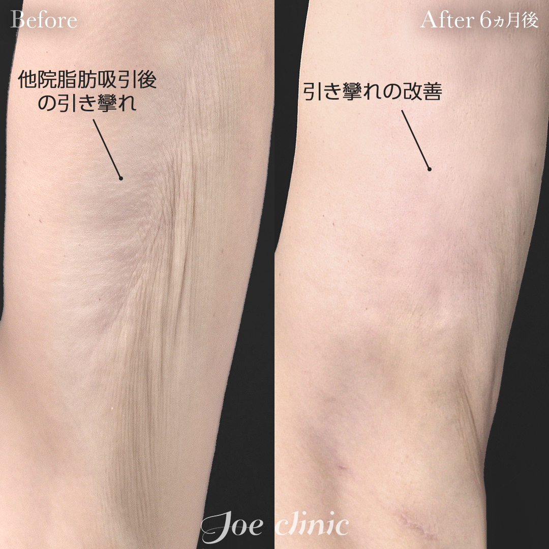 【40代女性・他院修正】脂肪吸引（二の腕）+ナノファット注入｜6ヵ月後