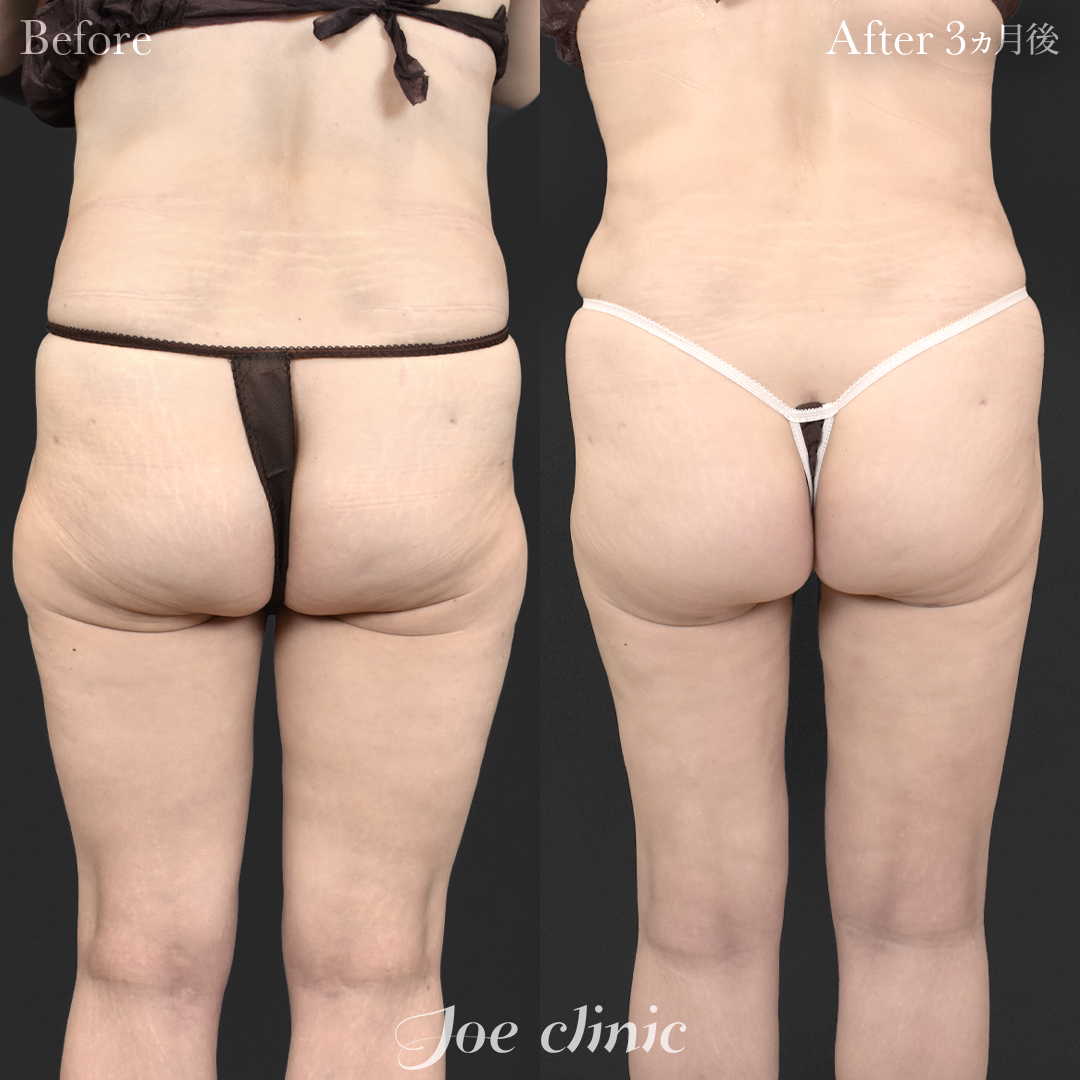 【50代女性・他院修正】脂肪吸引（腹部・太もも・膝）