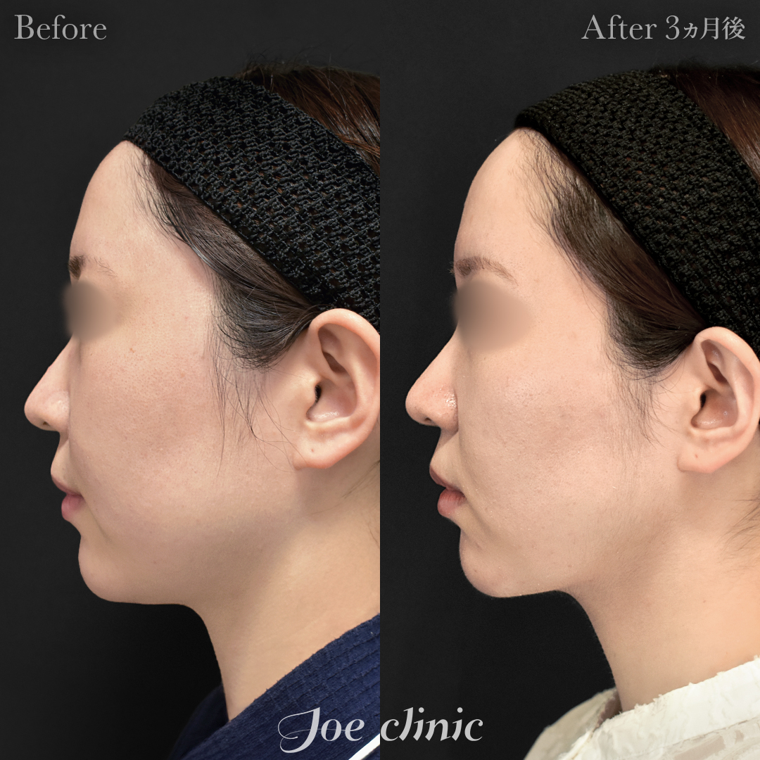 【20代女性】脂肪吸引(顔全体)|3ヵ月後