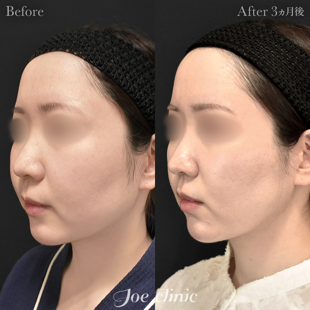 【20代女性】脂肪吸引(顔全体)|3ヵ月後