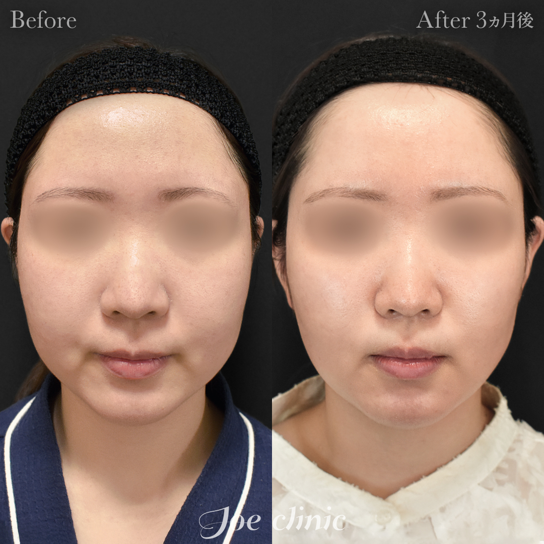 【20代女性】脂肪吸引(顔全体)|3ヵ月後