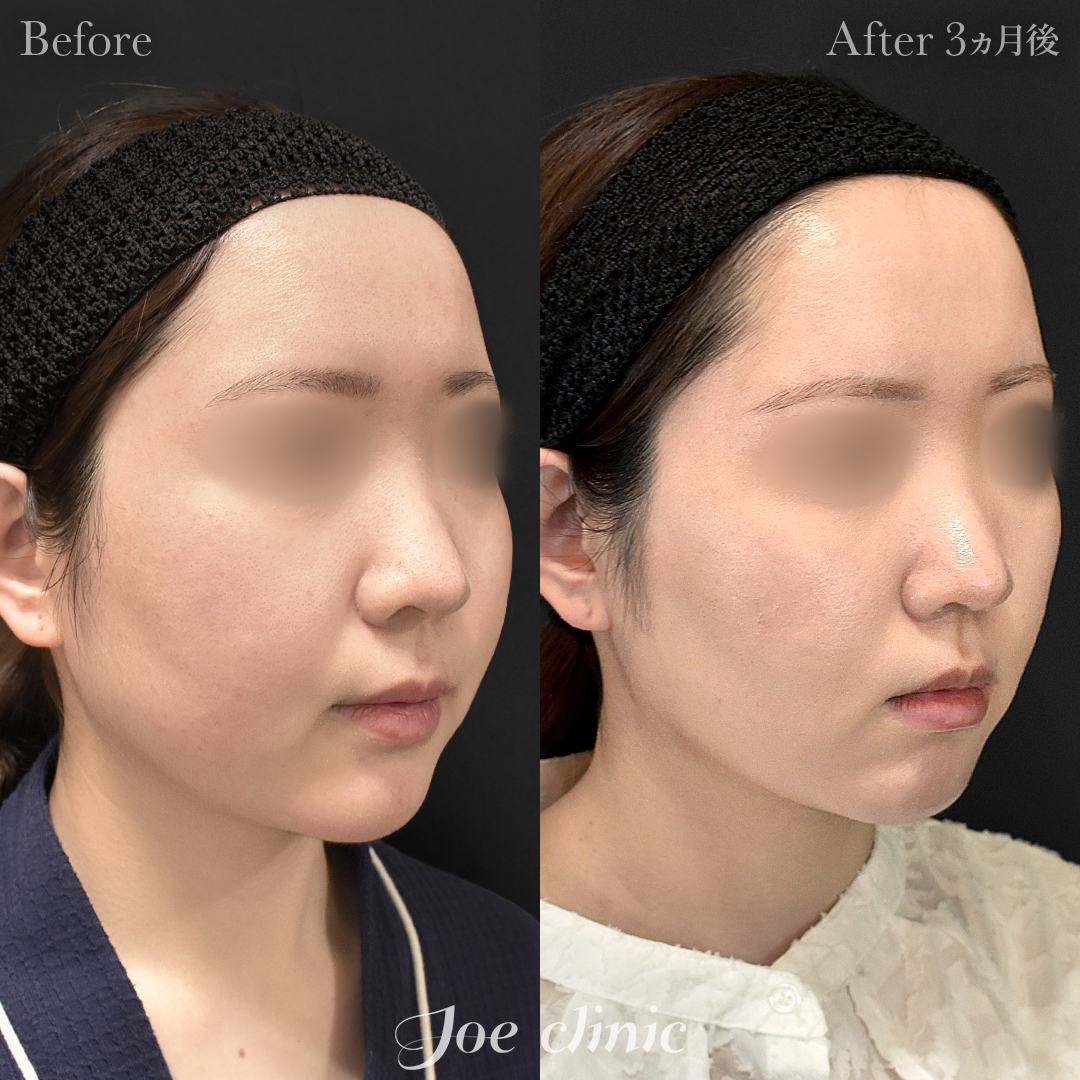 【20代女性】脂肪吸引(顔全体)|3ヵ月後