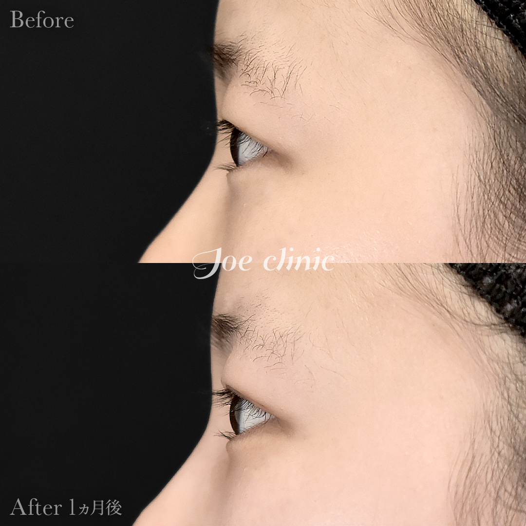 【30代女性】二重全切開法|1ヵ月後