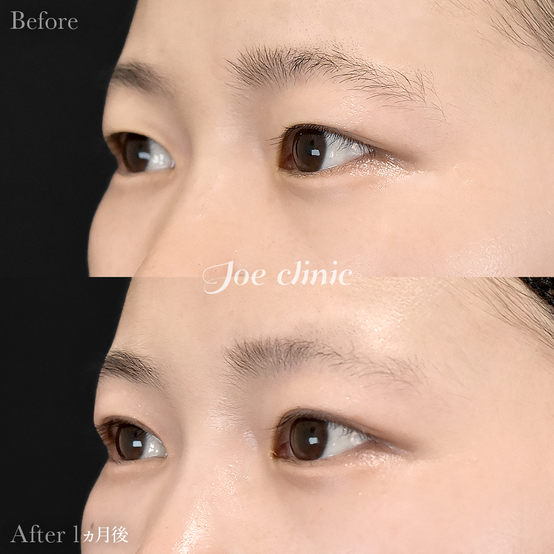 【30代女性】二重全切開法|1ヵ月後