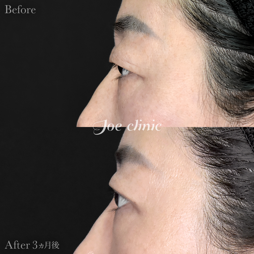 【40代女性】二重全切開法＋目の上たるみ・脂肪取り術｜3ヵ月後
