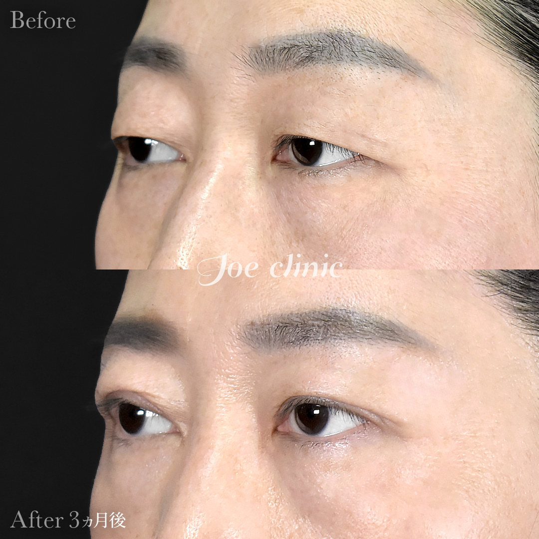 【40代女性】二重全切開法＋目の上たるみ・脂肪取り術｜3ヵ月後