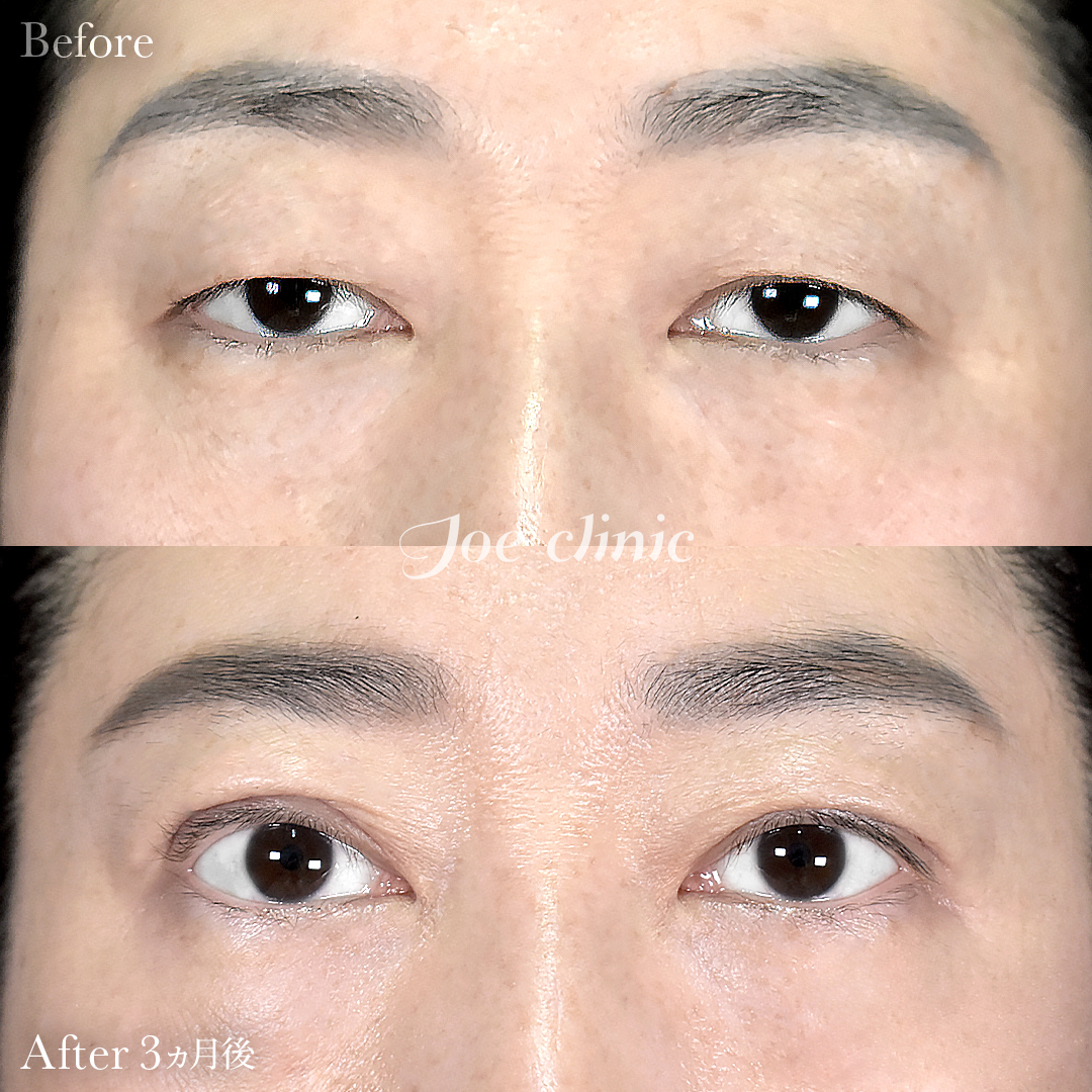 【40代女性】二重全切開法＋目の上たるみ・脂肪取り術｜3ヵ月後