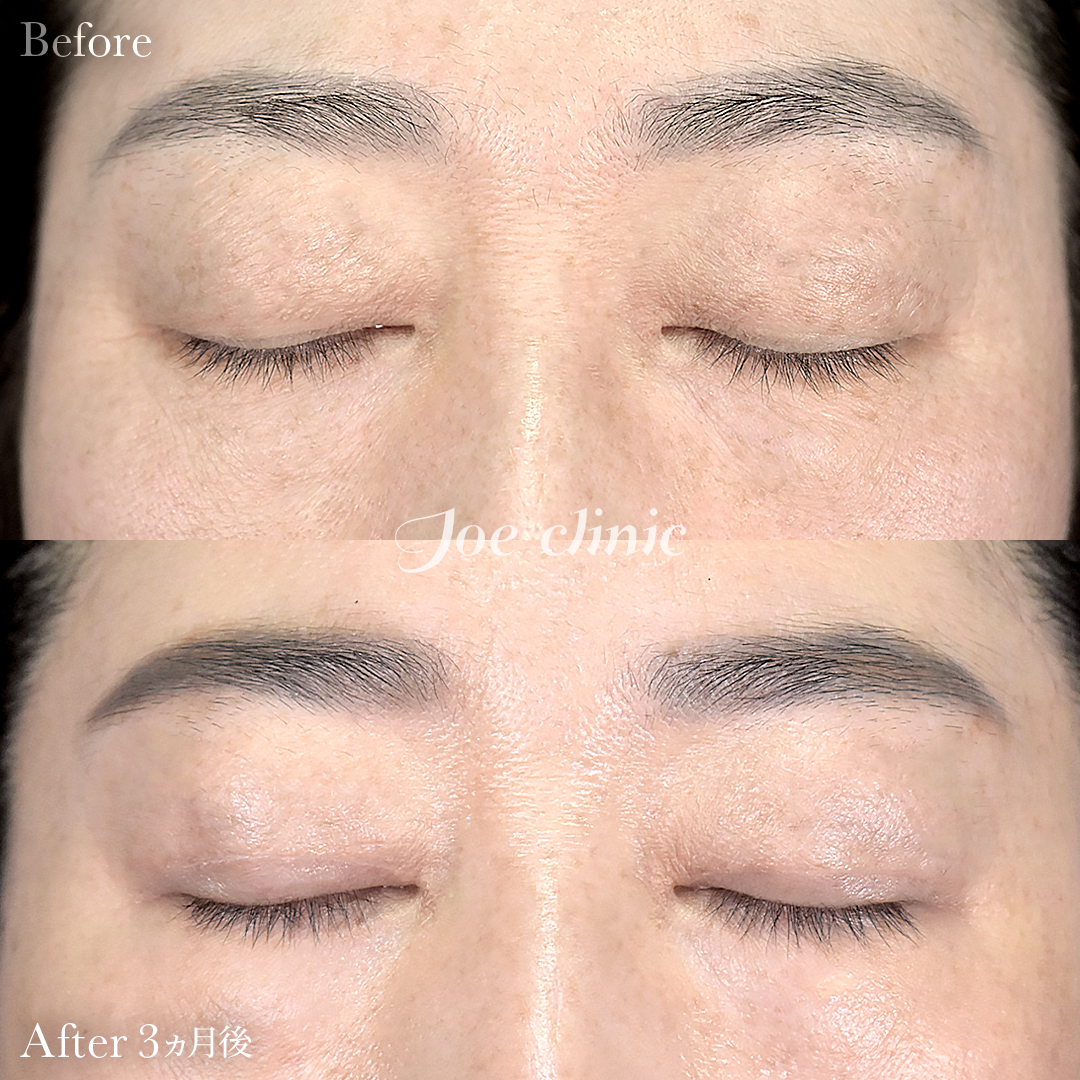 【40代女性】二重全切開法＋目の上たるみ・脂肪取り術｜3ヵ月後