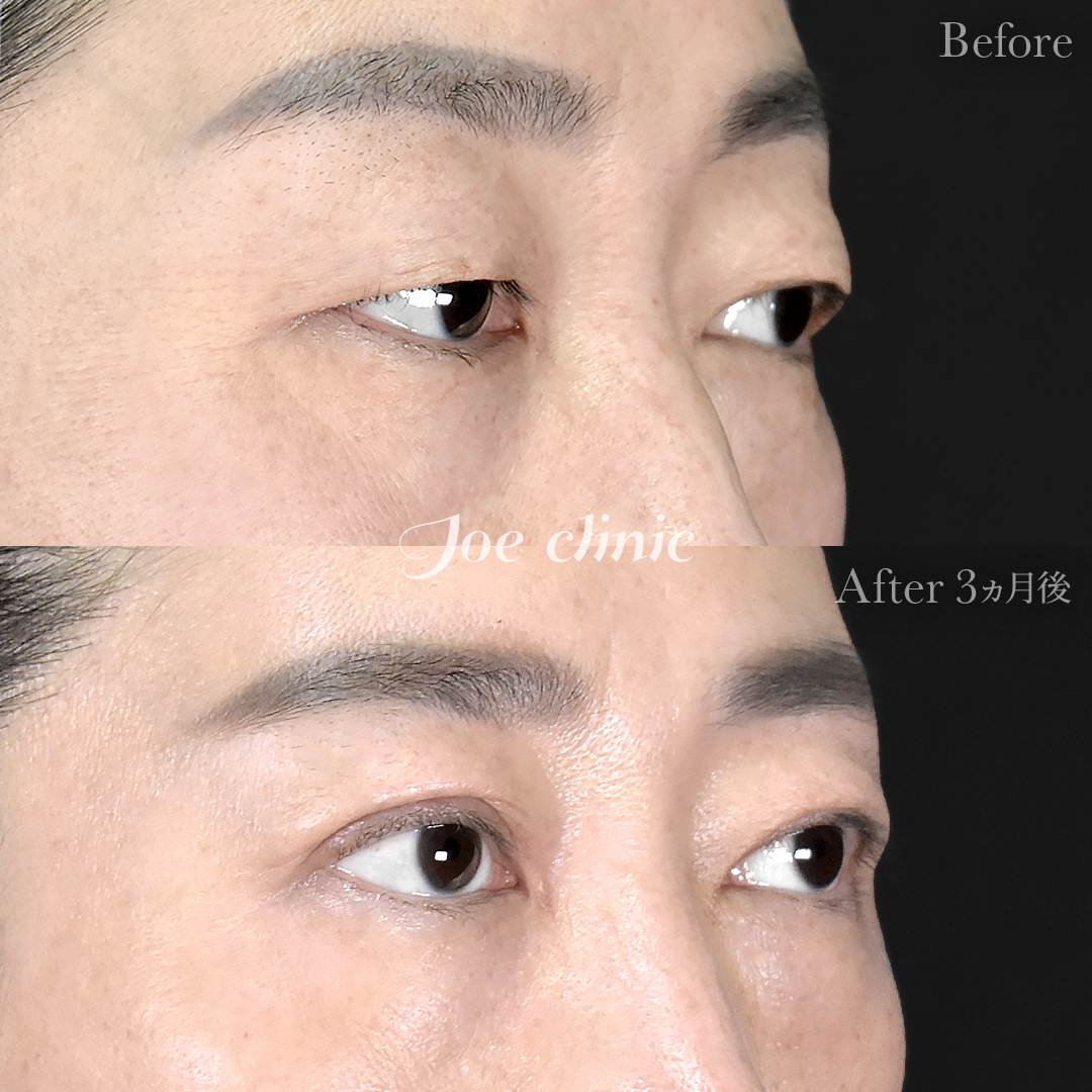 【40代女性】二重全切開法＋目の上たるみ・脂肪取り術｜3ヵ月後