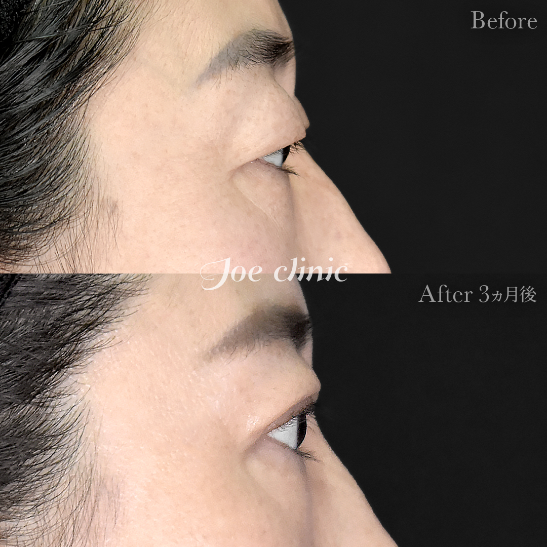 【40代女性】二重全切開法＋目の上たるみ・脂肪取り術｜3ヵ月後