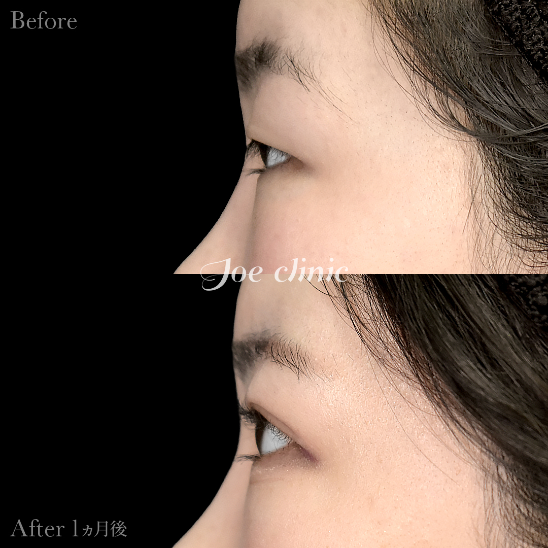 【10代女性】ジョウクリ式二重埋没法3点留め｜1ヵ月後