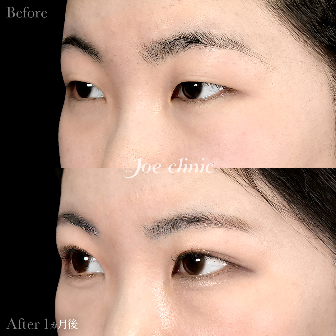 【10代女性】ジョウクリ式二重埋没法3点留め｜1ヵ月後