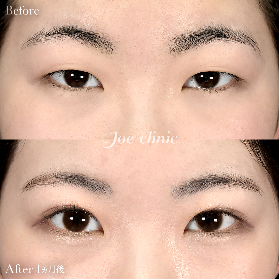 【10代女性】ジョウクリ式二重埋没法3点留め｜1ヵ月後