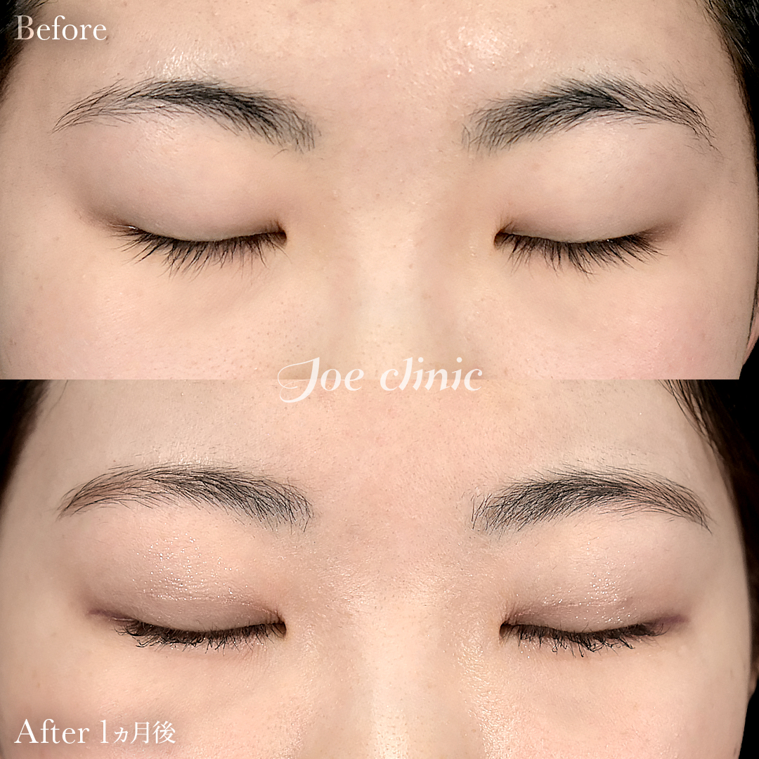 【10代女性】ジョウクリ式二重埋没法3点留め｜1ヵ月後