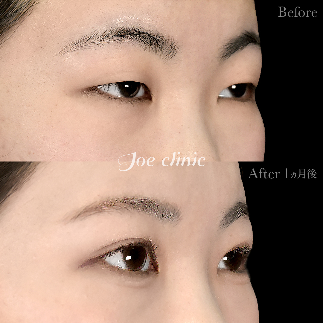 【10代女性】ジョウクリ式二重埋没法3点留め｜1ヵ月後