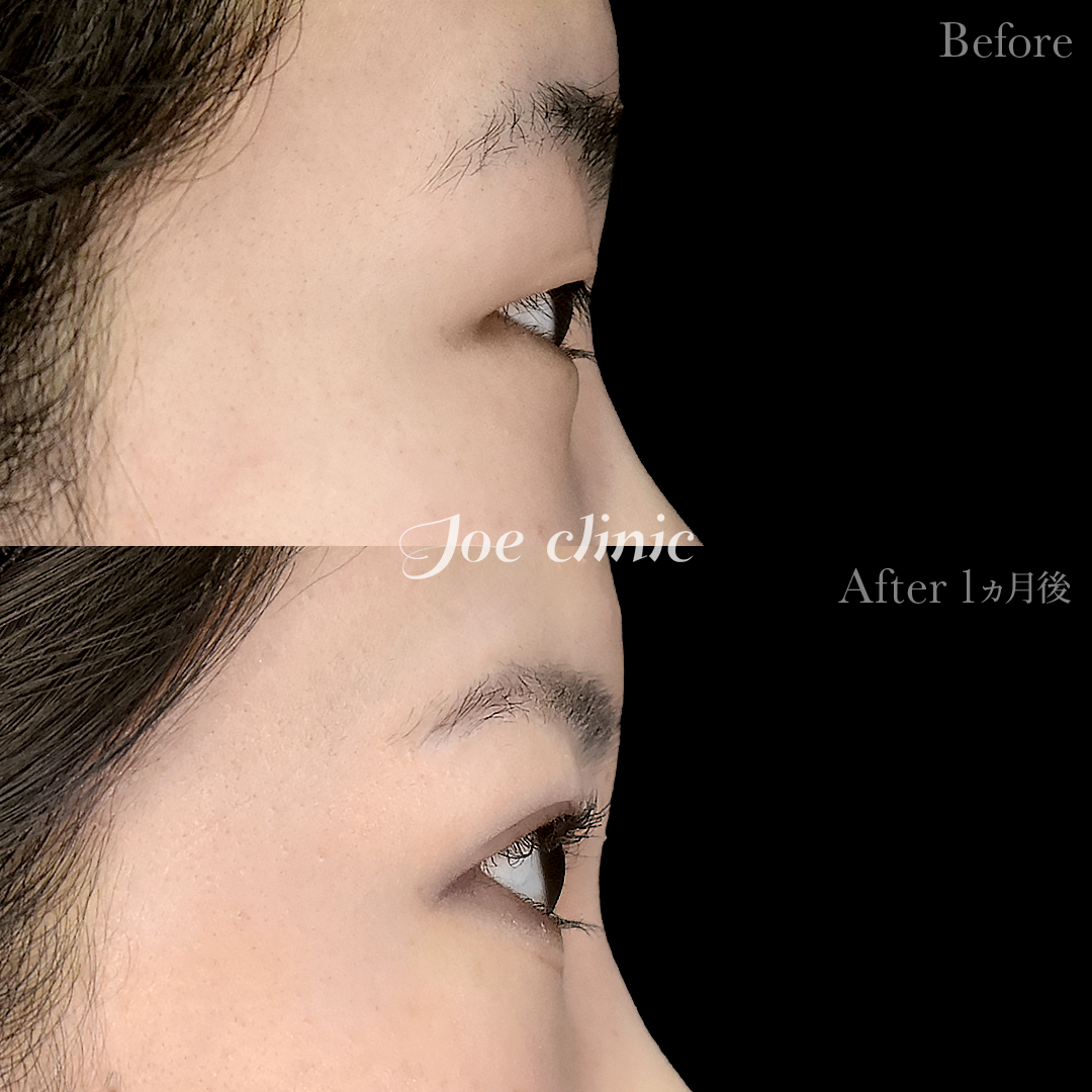 【10代女性】ジョウクリ式二重埋没法3点留め｜1ヵ月後