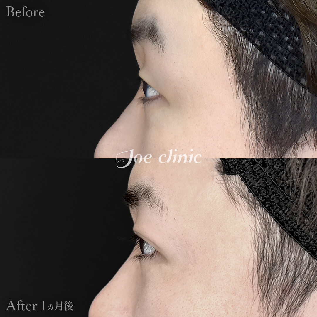 【20代男性】韓国式二重埋没法6点留め｜1ヵ月後